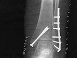 Broken Bone X-Ray